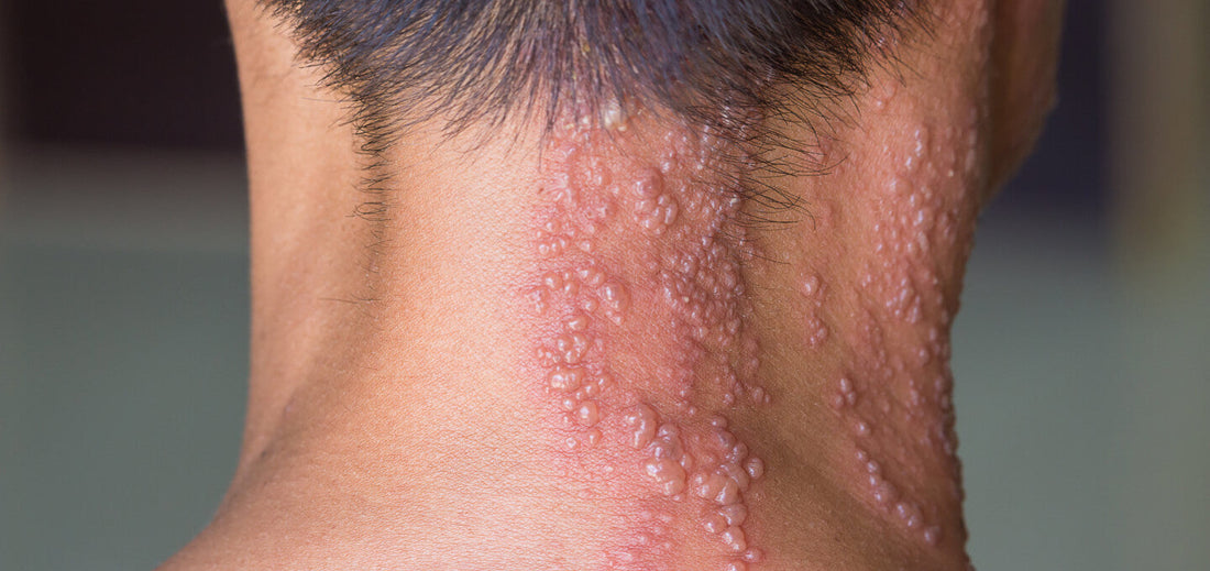 Health: What is Shingles - and how to deal with it.